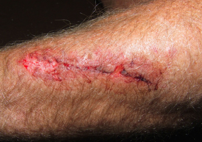 injury